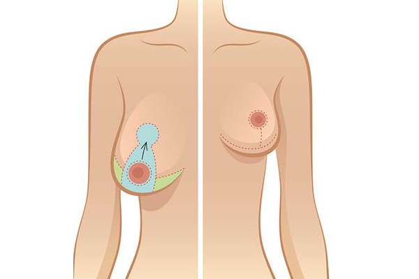 Tìm Hiểu Về Phương Pháp Nâng Sa Trễ - Điểm Khác Biệt So Với Nâng Ngực