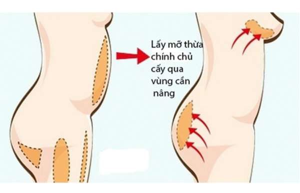 Cấy Mỡ Tự Thân Vòng 1: Ưu Điểm, Thời Gian Duy Trì Kết Quả