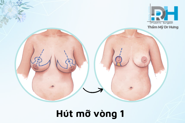 Phẫu Thuật Hút Mỡ Vòng 1 Là Gì? Có Ảnh Hưởng Tới Việc Cho Con Bú?