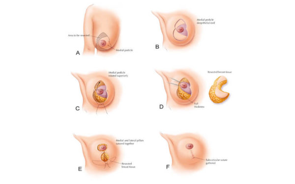 Phẫu Thuật Hút Mỡ Vòng 1 Là Gì? Có Ảnh Hưởng Tới Việc Cho Con Bú?