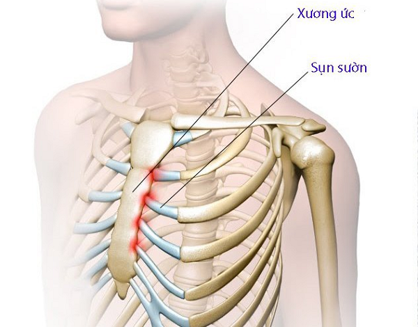 Sụn Sườn Nâng Mũi Lấy Ở Đâu? Sụn Có Tự Tái Tạo Lại Được Không?
