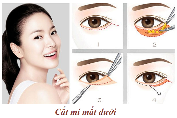 Tìm Hiểu Về Phương Pháp Loại Bỏ Bọng Mắt - Cắt Mí Mắt Dưới
