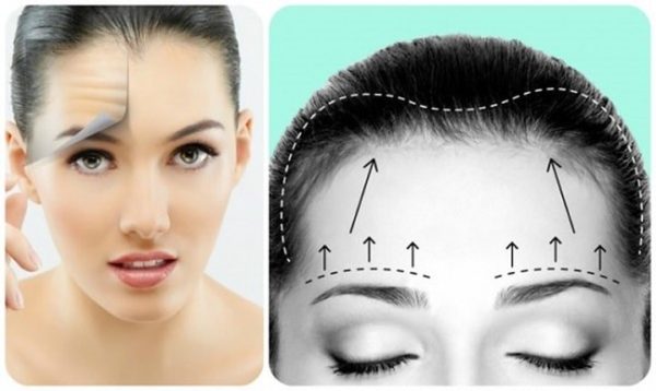 Căng Da Mặt Nội Soi - Chia Sẻ Từ Thẩm Mỹ Dr Hưng