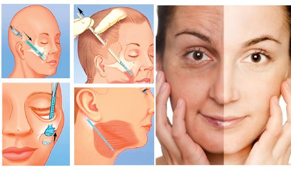 Căng Da Mặt Nội Soi - Chia Sẻ Từ Thẩm Mỹ Dr Hưng